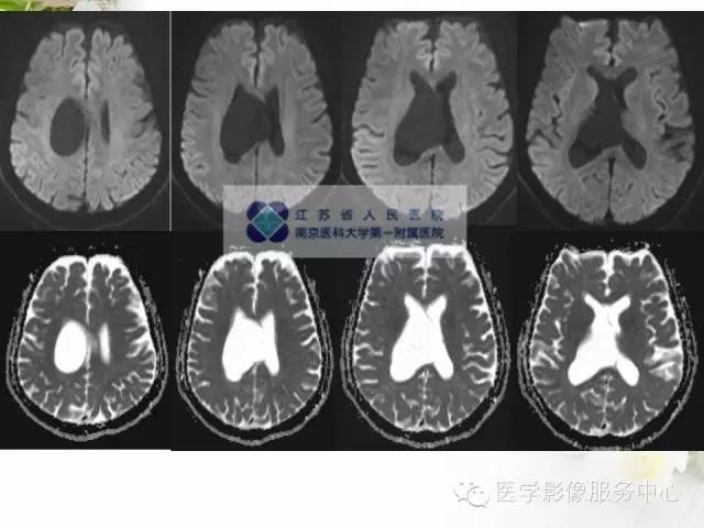【病例】中枢神经细胞瘤1例MR影像表现 【病例】中枢神经细胞瘤1例MR影像表现