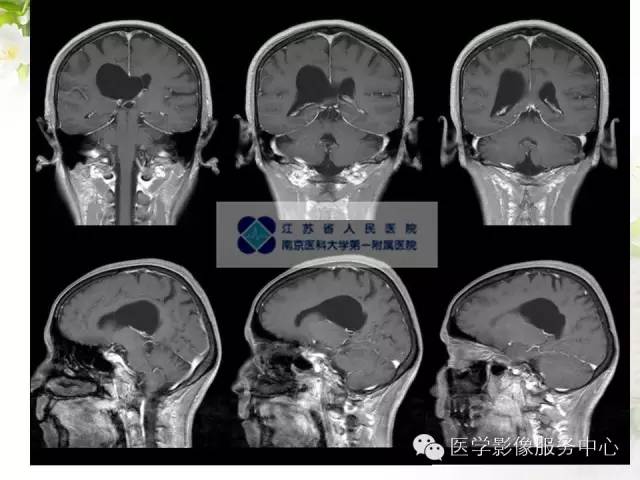 【病例】中枢神经细胞瘤1例MR影像表现 【病例】中枢神经细胞瘤1例MR影像表现