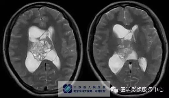 【病例】中枢神经细胞瘤1例MR影像表现 【病例】中枢神经细胞瘤1例MR影像表现