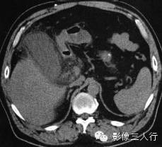 急性胆嚢炎的CT报告书写技巧与提示