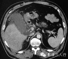 急性胆嚢炎的CT报告书写技巧与提示 急性胆嚢炎的CT报告书写技巧与提示