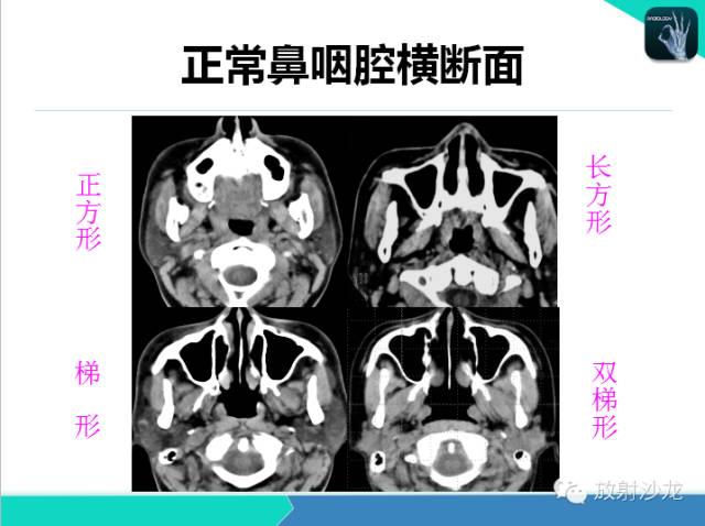 【PPT】鼻咽部CT解剖