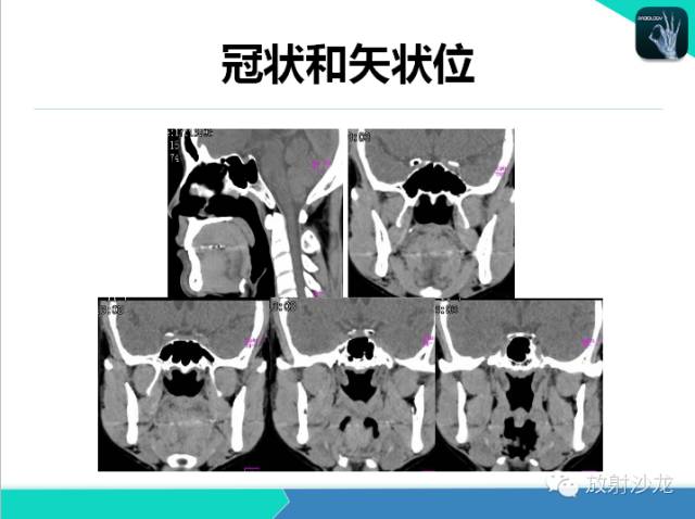 【PPT】鼻咽部CT解剖