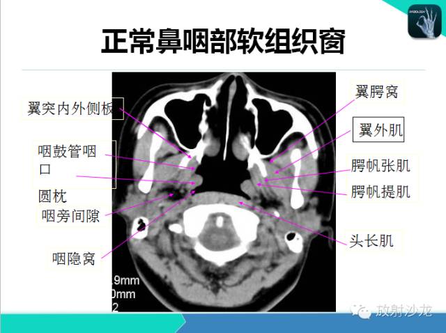 【PPT】鼻咽部CT解剖