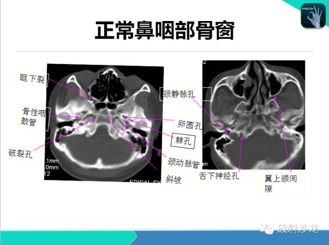 【PPT】鼻咽部CT解剖