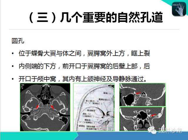 【PPT】鼻咽部CT解剖