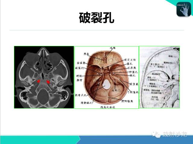 【PPT】鼻咽部CT解剖