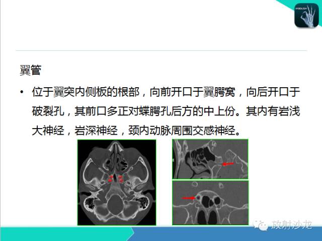 【PPT】鼻咽部CT解剖