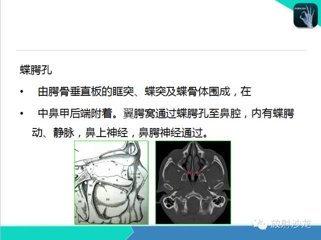 【PPT】鼻咽部CT解剖