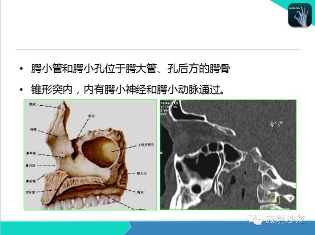 【PPT】鼻咽部CT解剖