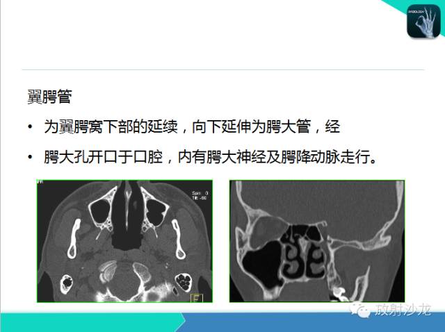 【PPT】鼻咽部CT解剖