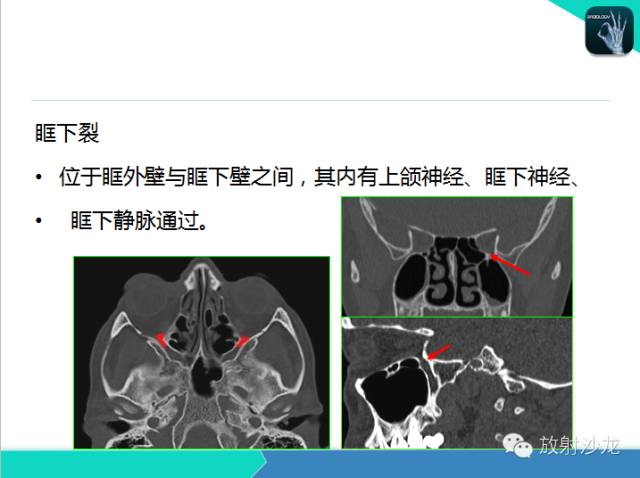 【PPT】鼻咽部CT解剖