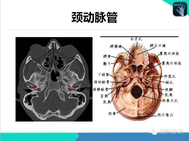 【PPT】鼻咽部CT解剖