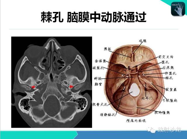 【PPT】鼻咽部CT解剖