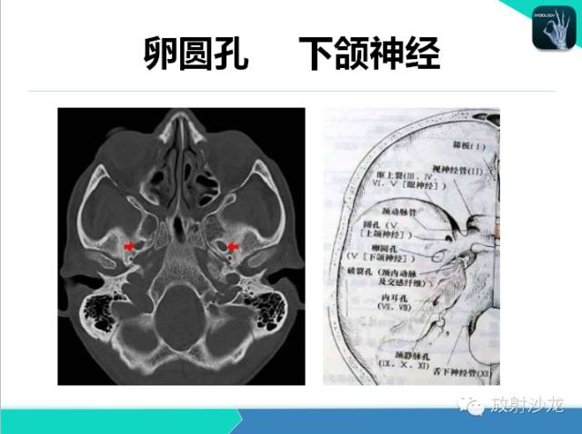 【PPT】鼻咽部CT解剖