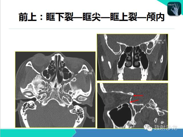【PPT】鼻咽部CT解剖