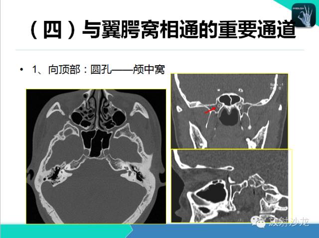 【PPT】鼻咽部CT解剖