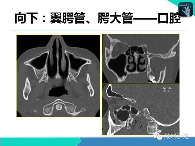 【PPT】鼻咽部CT解剖