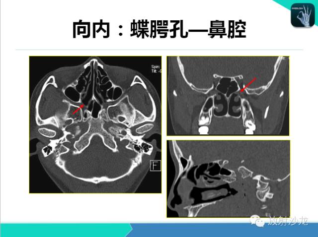 【PPT】鼻咽部CT解剖