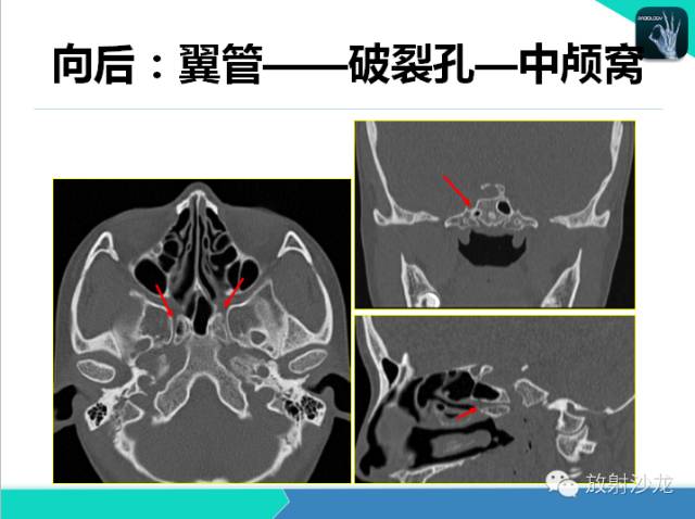 【PPT】鼻咽部CT解剖