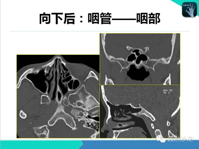 【PPT】鼻咽部CT解剖