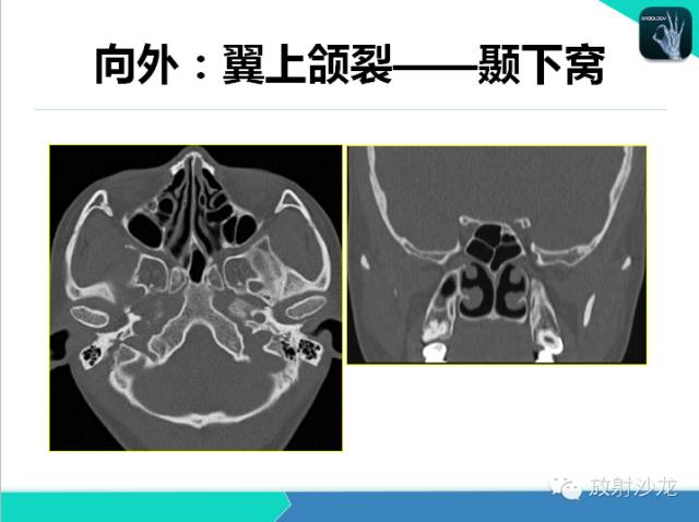 【PPT】鼻咽部CT解剖