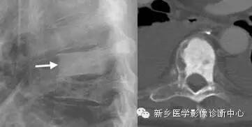 盘点那些引起椎体密度增高的疾病 盘点那些引起椎体密度增高的疾病