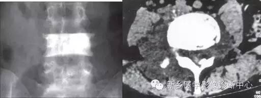 盘点那些引起椎体密度增高的疾病 盘点那些引起椎体密度增高的疾病