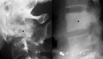 盘点那些引起椎体密度增高的疾病 盘点那些引起椎体密度增高的疾病