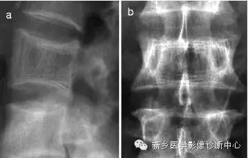 盘点那些引起椎体密度增高的疾病 盘点那些引起椎体密度增高的疾病