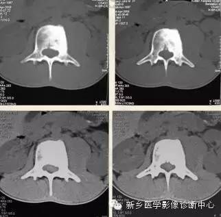 盘点那些引起椎体密度增高的疾病 盘点那些引起椎体密度增高的疾病