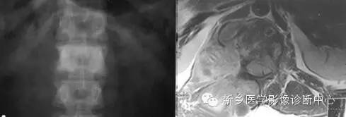 盘点那些引起椎体密度增高的疾病 盘点那些引起椎体密度增高的疾病