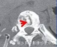 盘点那些引起椎体密度增高的疾病 盘点那些引起椎体密度增高的疾病