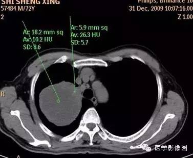【病例】右上肺鳞癌伴广泛坏死1例CT影像表现 【病例】右上肺鳞癌伴广泛坏死1例CT影像表现