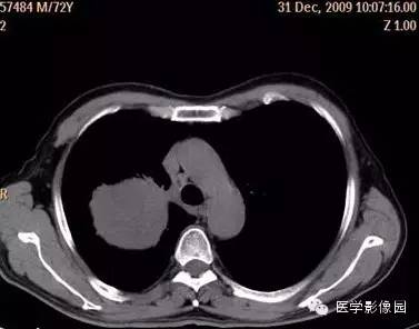 【病例】右上肺鳞癌伴广泛坏死1例CT影像表现 【病例】右上肺鳞癌伴广泛坏死1例CT影像表现