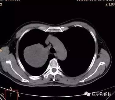 【病例】右上肺鳞癌伴广泛坏死1例CT影像表现 【病例】右上肺鳞癌伴广泛坏死1例CT影像表现