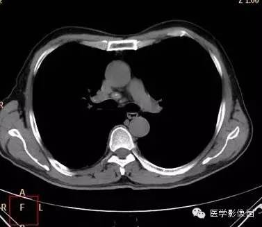 【病例】右上肺鳞癌伴广泛坏死1例CT影像表现 【病例】右上肺鳞癌伴广泛坏死1例CT影像表现