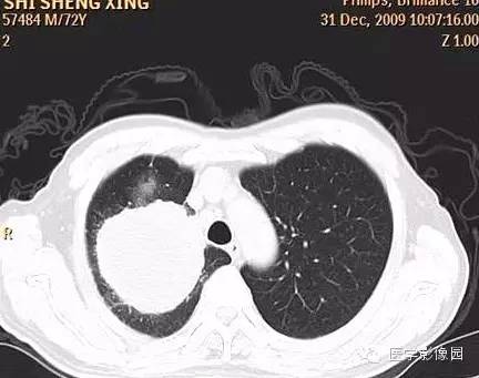 【病例】右上肺鳞癌伴广泛坏死1例CT影像表现 【病例】右上肺鳞癌伴广泛坏死1例CT影像表现
