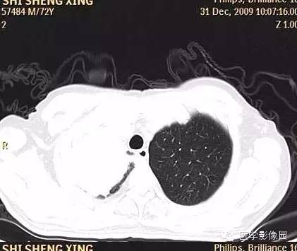 【病例】右上肺鳞癌伴广泛坏死1例CT影像表现 【病例】右上肺鳞癌伴广泛坏死1例CT影像表现