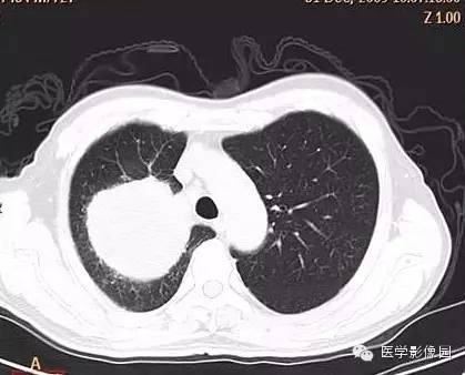 【病例】右上肺鳞癌伴广泛坏死1例CT影像表现 【病例】右上肺鳞癌伴广泛坏死1例CT影像表现