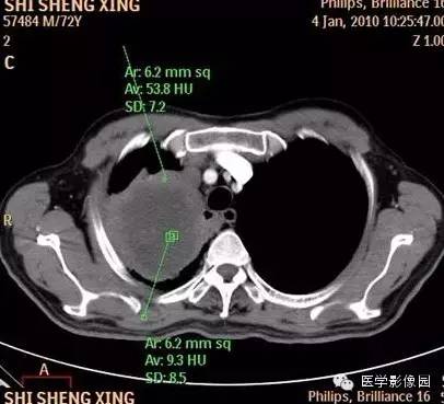 【病例】右上肺鳞癌伴广泛坏死1例CT影像表现 【病例】右上肺鳞癌伴广泛坏死1例CT影像表现