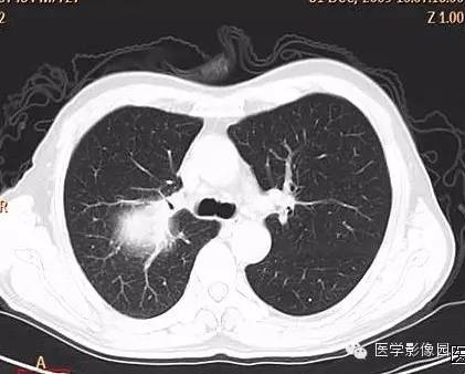 【病例】右上肺鳞癌伴广泛坏死1例CT影像表现 【病例】右上肺鳞癌伴广泛坏死1例CT影像表现