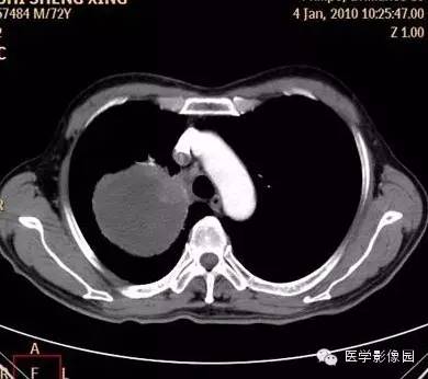 【病例】右上肺鳞癌伴广泛坏死1例CT影像表现 【病例】右上肺鳞癌伴广泛坏死1例CT影像表现