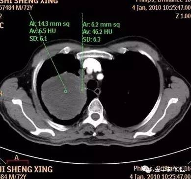 【病例】右上肺鳞癌伴广泛坏死1例CT影像表现 【病例】右上肺鳞癌伴广泛坏死1例CT影像表现