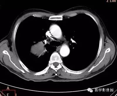 【病例】右上肺鳞癌伴广泛坏死1例CT影像表现 【病例】右上肺鳞癌伴广泛坏死1例CT影像表现