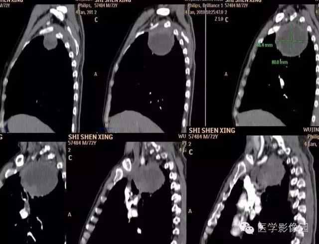 【病例】右上肺鳞癌伴广泛坏死1例CT影像表现 【病例】右上肺鳞癌伴广泛坏死1例CT影像表现