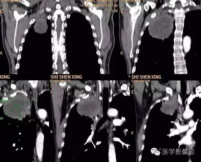【病例】右上肺鳞癌伴广泛坏死1例CT影像表现 【病例】右上肺鳞癌伴广泛坏死1例CT影像表现
