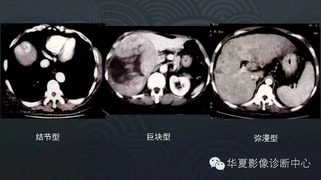 【PPT】肝细胞肝癌的分类及分期