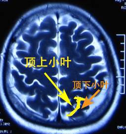 从解剖到影像,看透顶叶 从解剖到影像,看透顶叶
