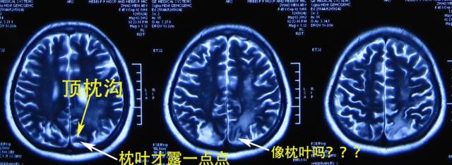 从解剖到影像,看透顶叶 从解剖到影像,看透顶叶